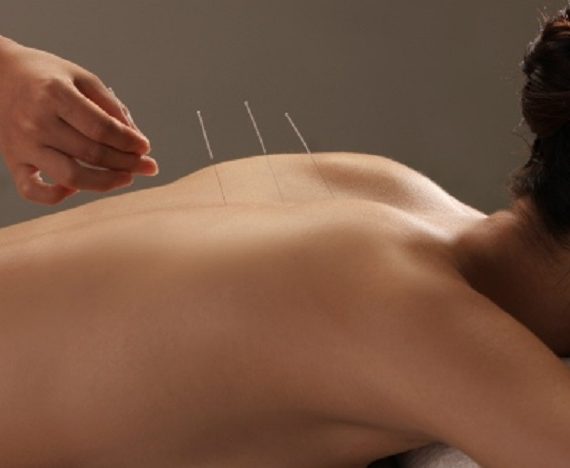 Ce este acupunctura?