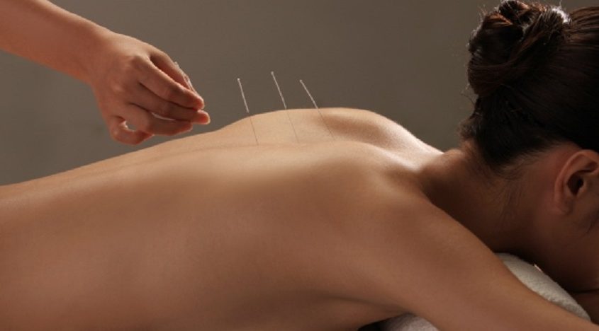 Ce este acupunctura?