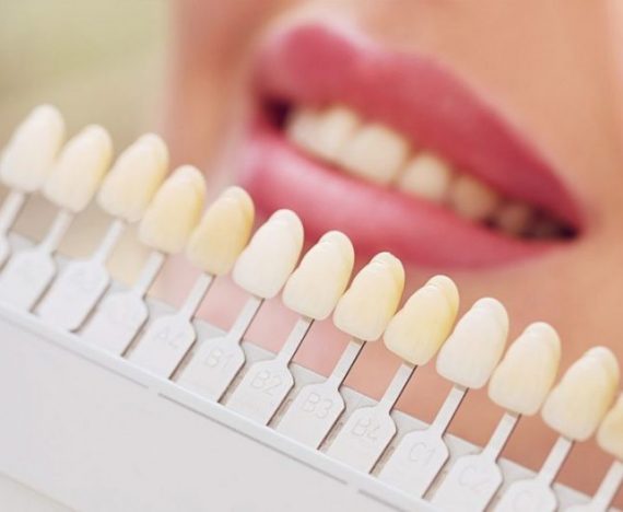 Ce sunt fatetele dentare?