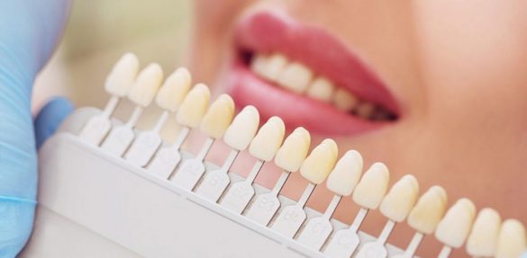 Ce sunt fatetele dentare?