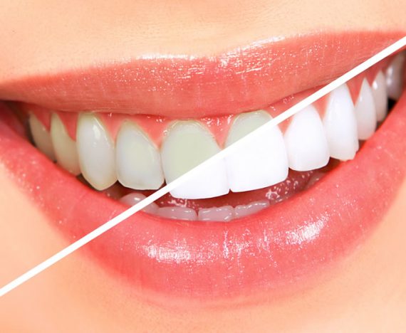 Beneficii ale albirii profesionale a dintilor