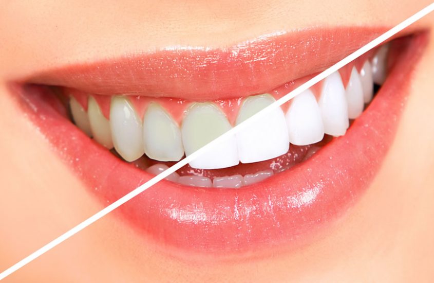 Beneficii ale albirii profesionale a dintilor