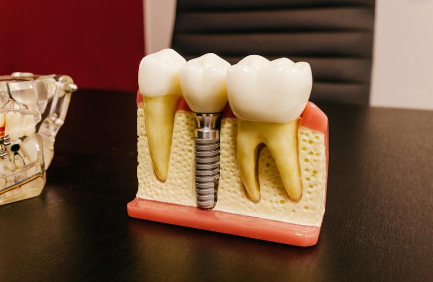 Beneficiile implanturilor dentare tot ce trebuie să știi PontiFex